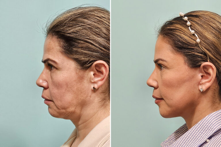 Before and after facelift and neck lift, side profile: jowls, heaviness and a soft neck