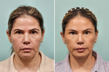 Before and after Brow Lift by Dr. Shervin Naderi, Patient 42843