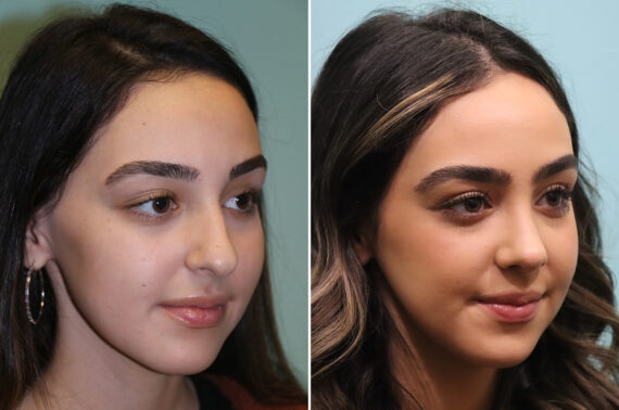 Before and after Rhinoplasty by Dr. Shervin Naderi, Patient 42922