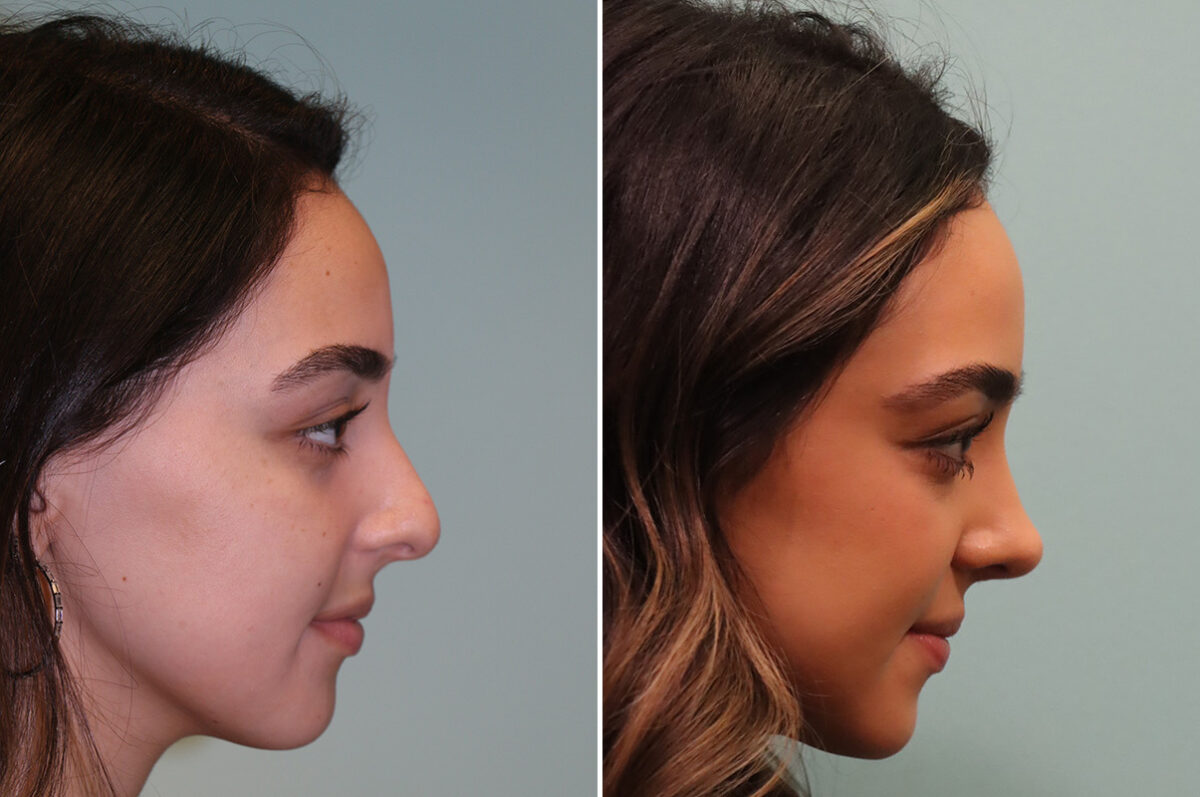Before and after Rhinoplasty by Dr. Shervin Naderi, Patient 42922