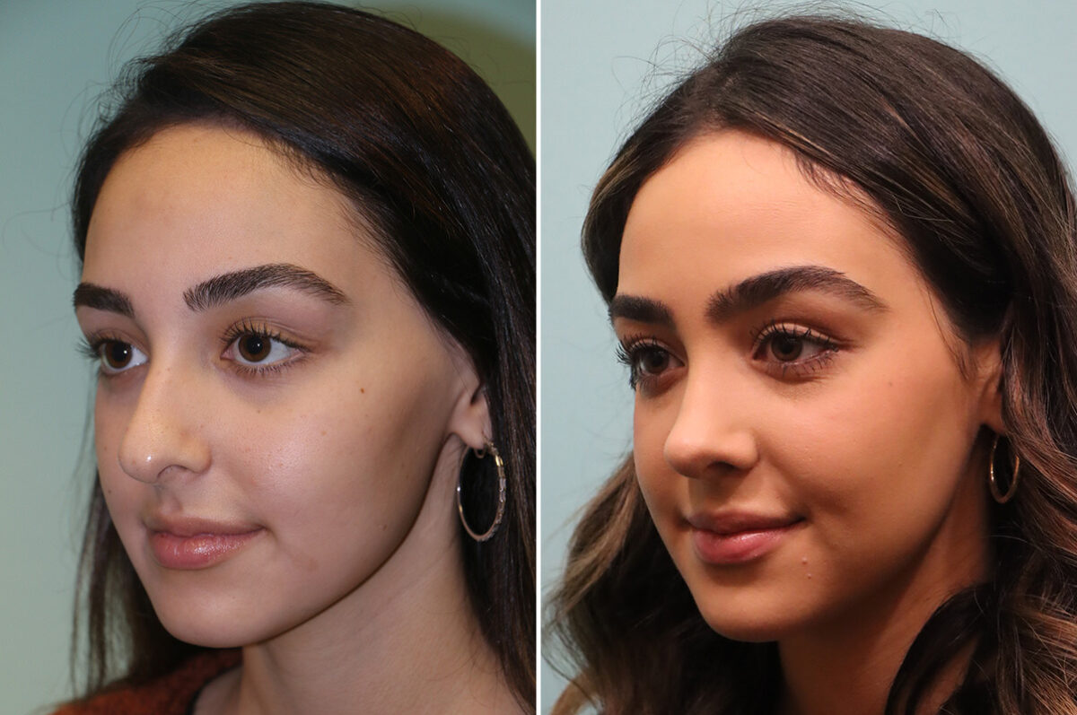 Before and after Rhinoplasty by Dr. Shervin Naderi, Patient 42922
