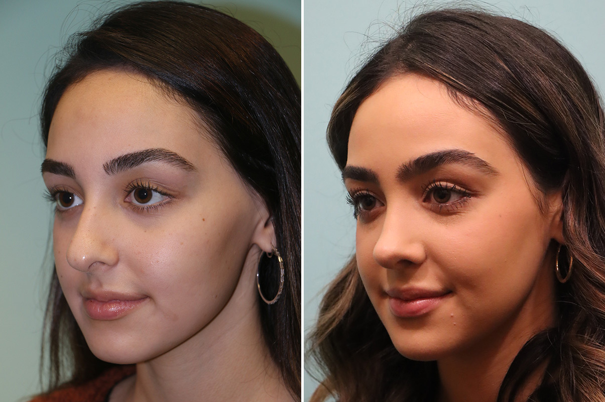 patient-42922-rhinoplasty-before-after