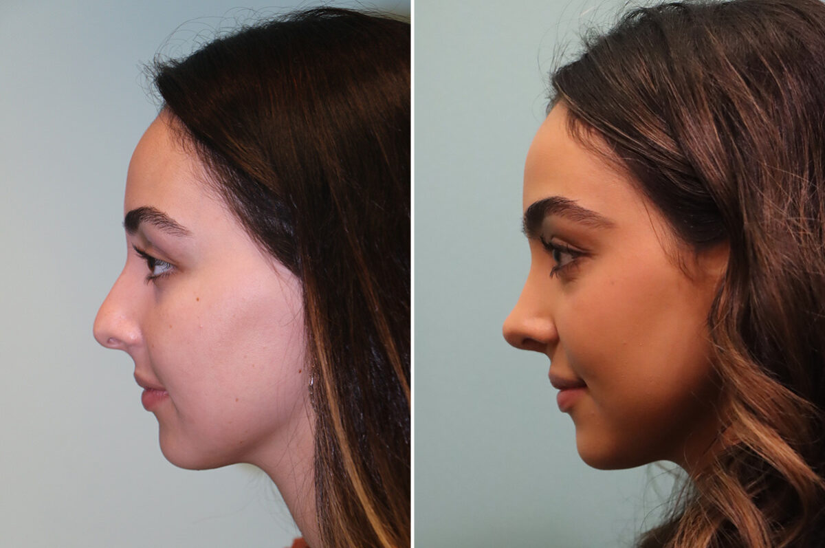 Before and after Rhinoplasty by Dr. Shervin Naderi, Patient 42922