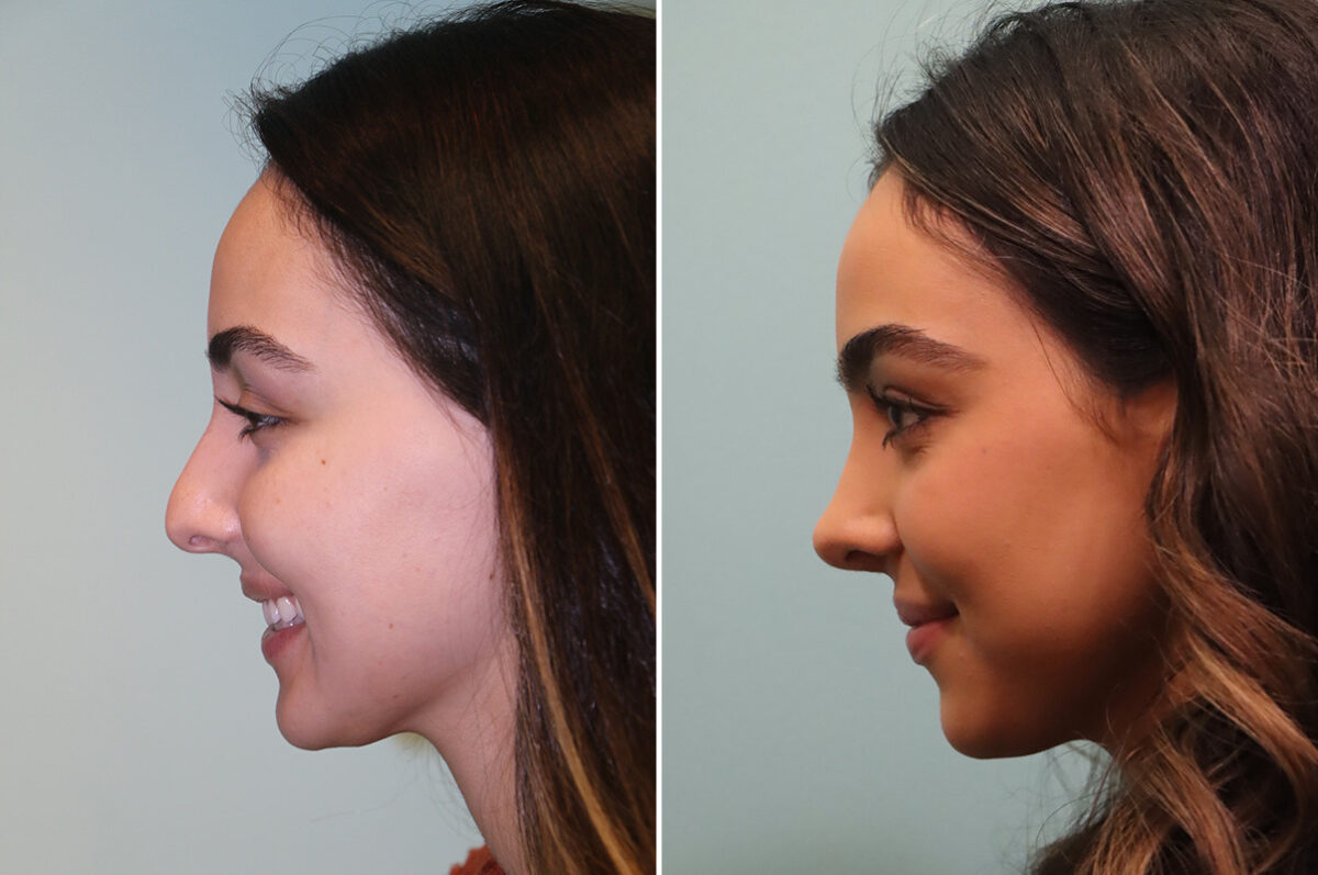 Before and after Rhinoplasty by Dr. Shervin Naderi, Patient 42922