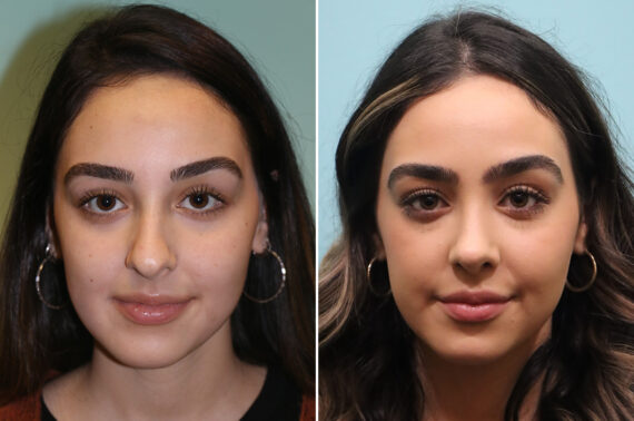 Before and after Rhinoplasty by Dr. Shervin Naderi, Patient 42922