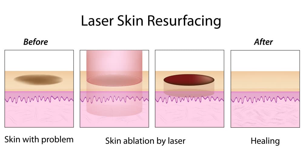 Diagram illustrating ablative laser skin resurfacing process, from removing damaged skin to healing with smoother texture