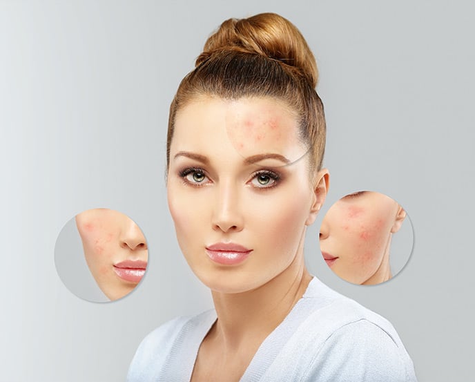 Woman with visible acne and close-up insets showing inflamed pimples on forehead, cheek, and jawline