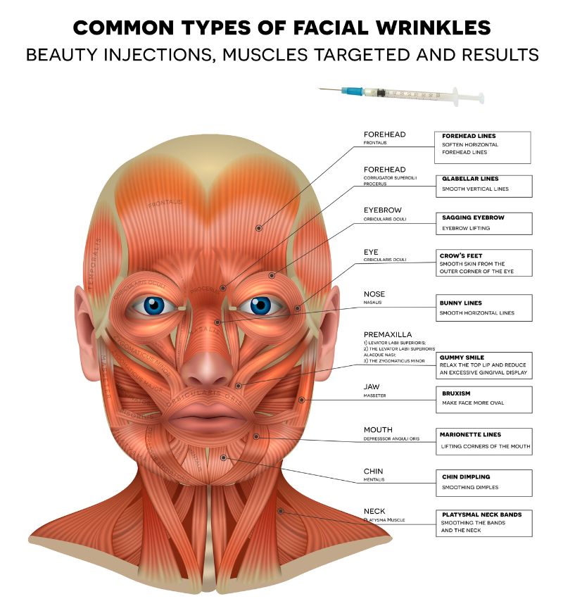 Diagram of facial muscles showing common wrinkle areas targeted by Brotox, including forehead, eyes, and jaw
