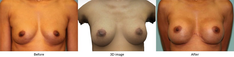 Before, 3D simulation, and after images showing breast augmentation planning with the Crisalix 3D system
