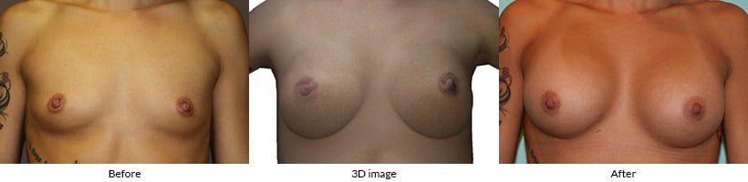 Before, 3D simulation, and after images showing breast augmentation results using Crisalix imaging