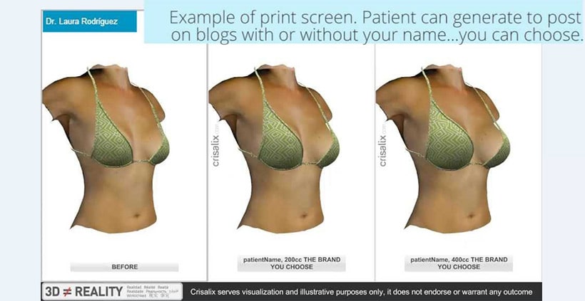Crisalix 3D simulation showing before and after previews of breast augmentation with different implant sizes