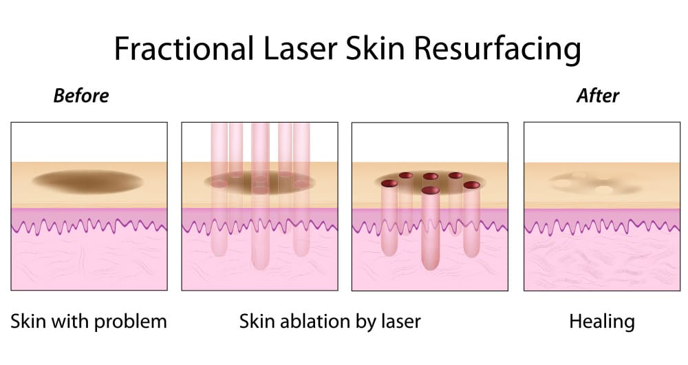 Diagram showing fractional laser skin resurfacing process targeting damaged skin with tiny beams while promoting healing