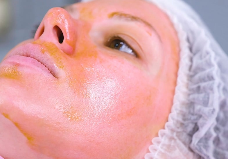 Woman’s face with visible peel solution applied during a medium-strength TCA chemical peel for skin rejuvenation