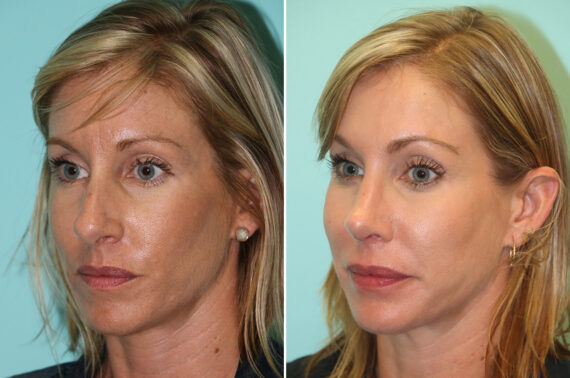 Before and after Rhinoplasty by Dr. Shervin Naderi, Patient 13917
