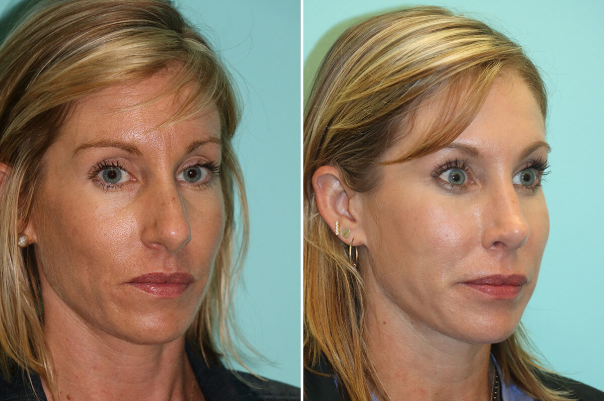 Patient 13917, Rhinoplasty Before and After Photos Before and after Rhinoplasty by Dr. Shervin Naderi, Patient 13917