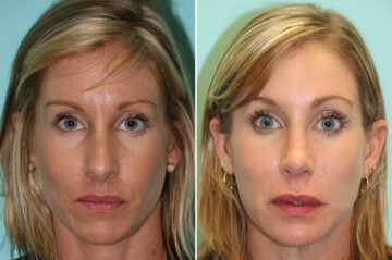 Before and after Rhinoplasty by Dr. Shervin Naderi, Patient 13917