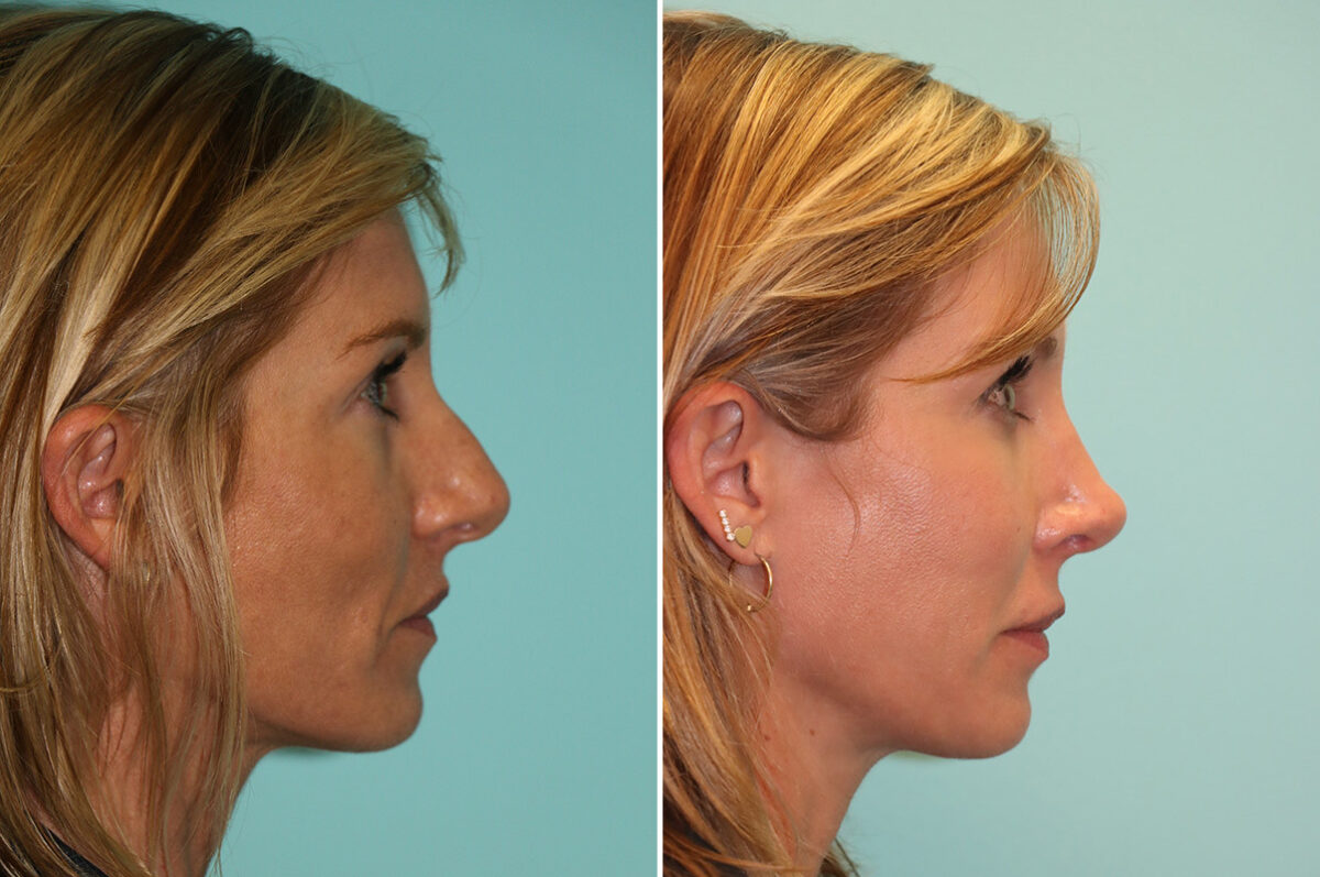Patient 13917, Rhinoplasty Before and After Photos Before and after Rhinoplasty by Dr. Shervin Naderi, Patient 13917