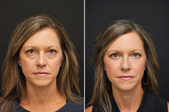 Before and after Blepharoplasty by Dr. Shervin Naderi, Patient 43116