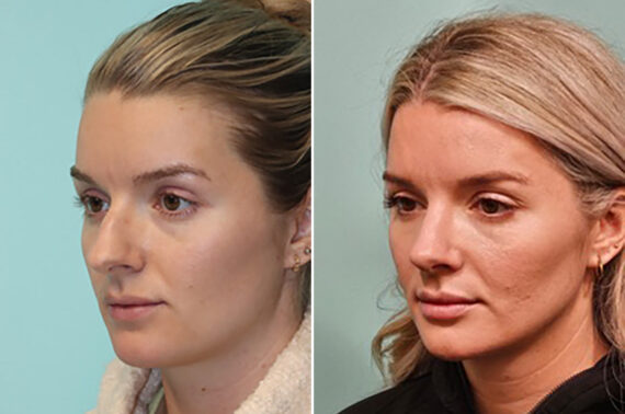 Before and after Rhinoplasty by Dr. Shervin Naderi, Patient 43708