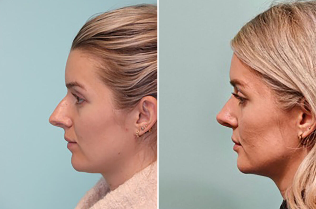 Patient 43708, Rhinoplasty Before and After Photos Before and after Rhinoplasty by Dr. Shervin Naderi, Patient 43708