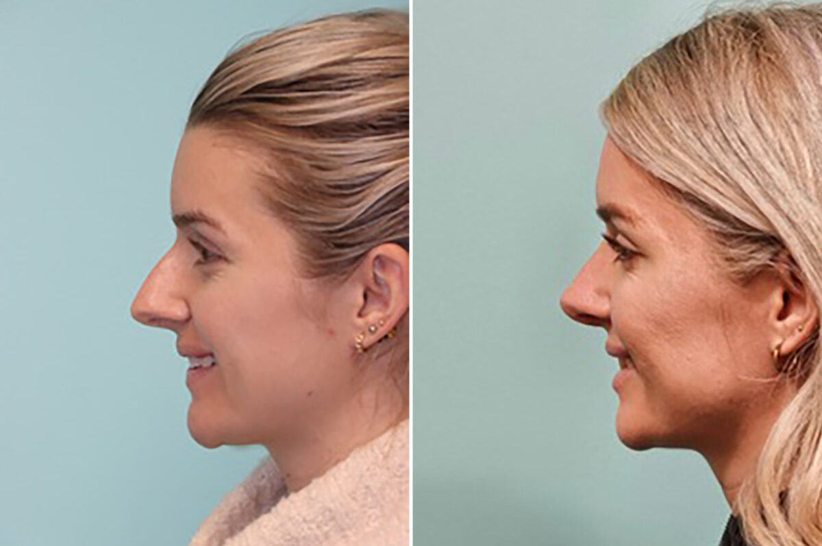 Patient 43708, Rhinoplasty Before and After Photos Before and after Rhinoplasty by Dr. Shervin Naderi, Patient 43708