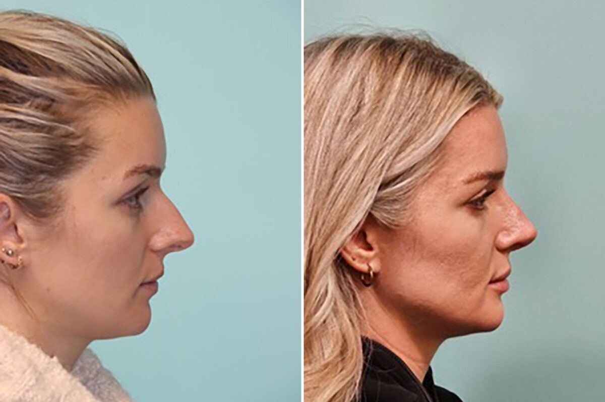 Patient 43708, Rhinoplasty Before and After Photos Before and after Rhinoplasty by Dr. Shervin Naderi, Patient 43708
