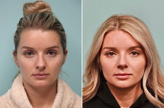 Before and after Rhinoplasty by Dr. Shervin Naderi, Patient 43708