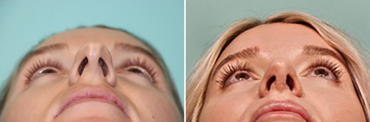Patient 43708, Rhinoplasty Before and After Photos Before and after Rhinoplasty by Dr. Shervin Naderi, Patient 43708