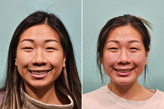 Before and after Rhinoplasty by Dr. Shervin Naderi, Patient 43744