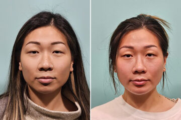 Before and after Rhinoplasty by Dr. Shervin Naderi, Patient 43744