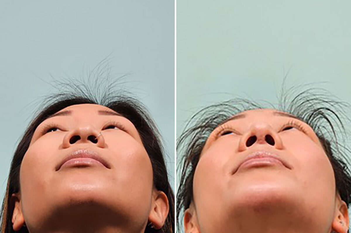 Patient 43744, Rhinoplasty Before and After Photos Before and after Rhinoplasty by Dr. Shervin Naderi, Patient 43744