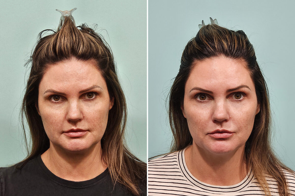 Patient 43759, Skin Resurfacing Before and After Photos Before and after Skin Resurfacing by Dr. Shervin Naderi, Patient 43759