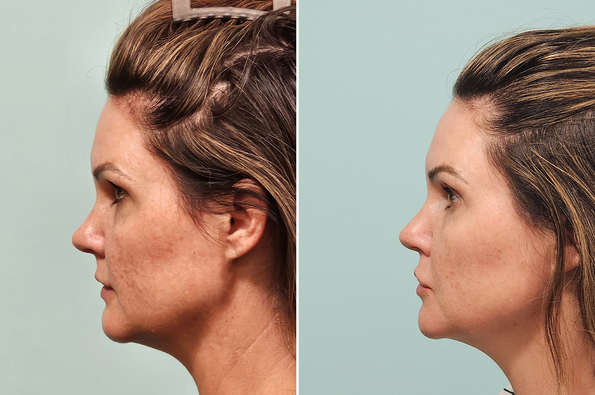 patient-43759-skin-resurfacing-before-after