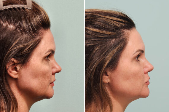 Before and after Skin Resurfacing by Dr. Shervin Naderi, Patient 43759