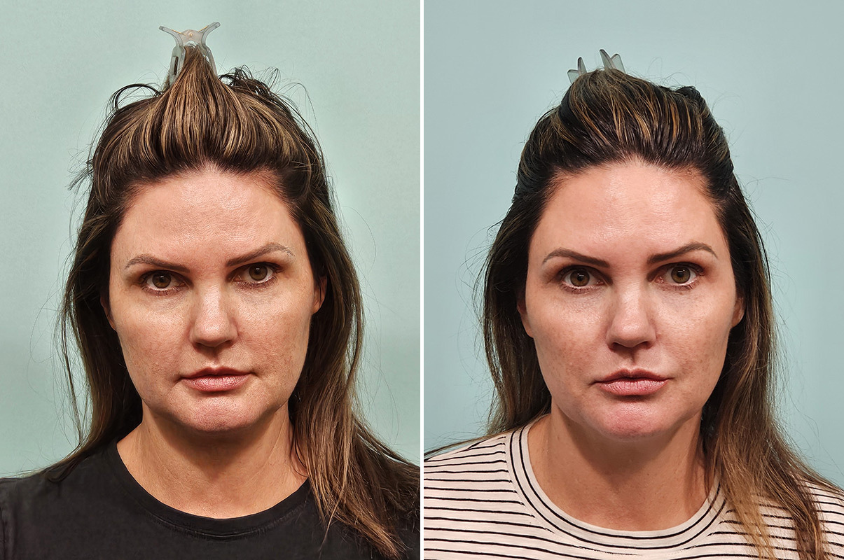 patient-43759-skin-resurfacing-before-after