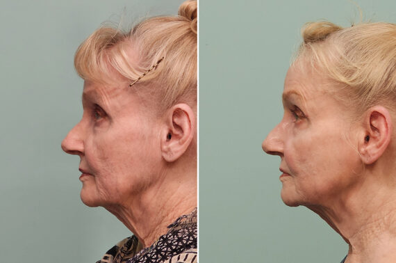 Before and after Skin Resurfacing by Dr. Shervin Naderi, Patient 43781