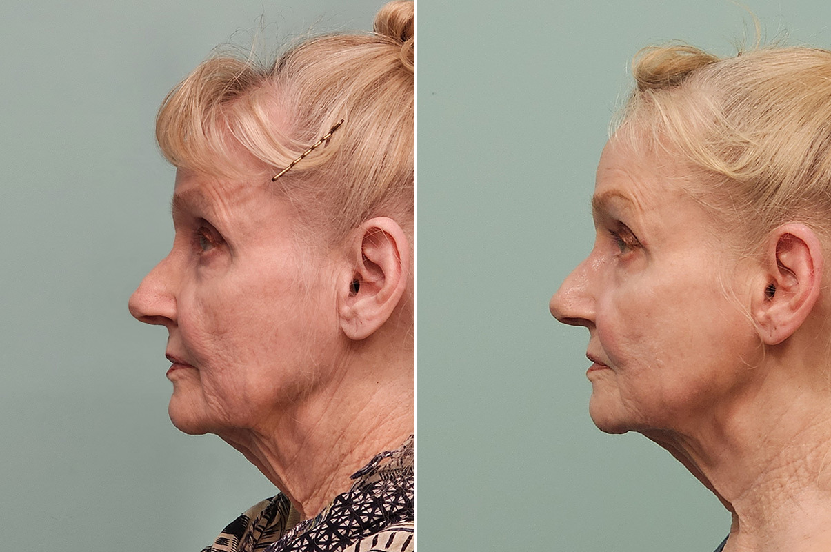 patient-43781-skin-resurfacing-before-after