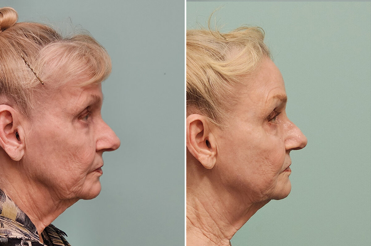 Before and after Skin Resurfacing by Dr. Shervin Naderi, Patient 43781