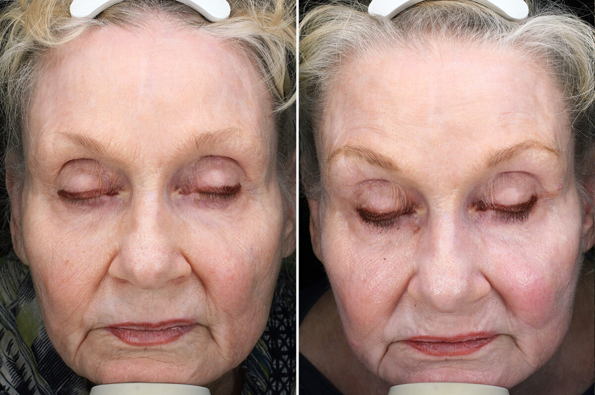Before and after Skin Resurfacing by Dr. Shervin Naderi, Patient 43781