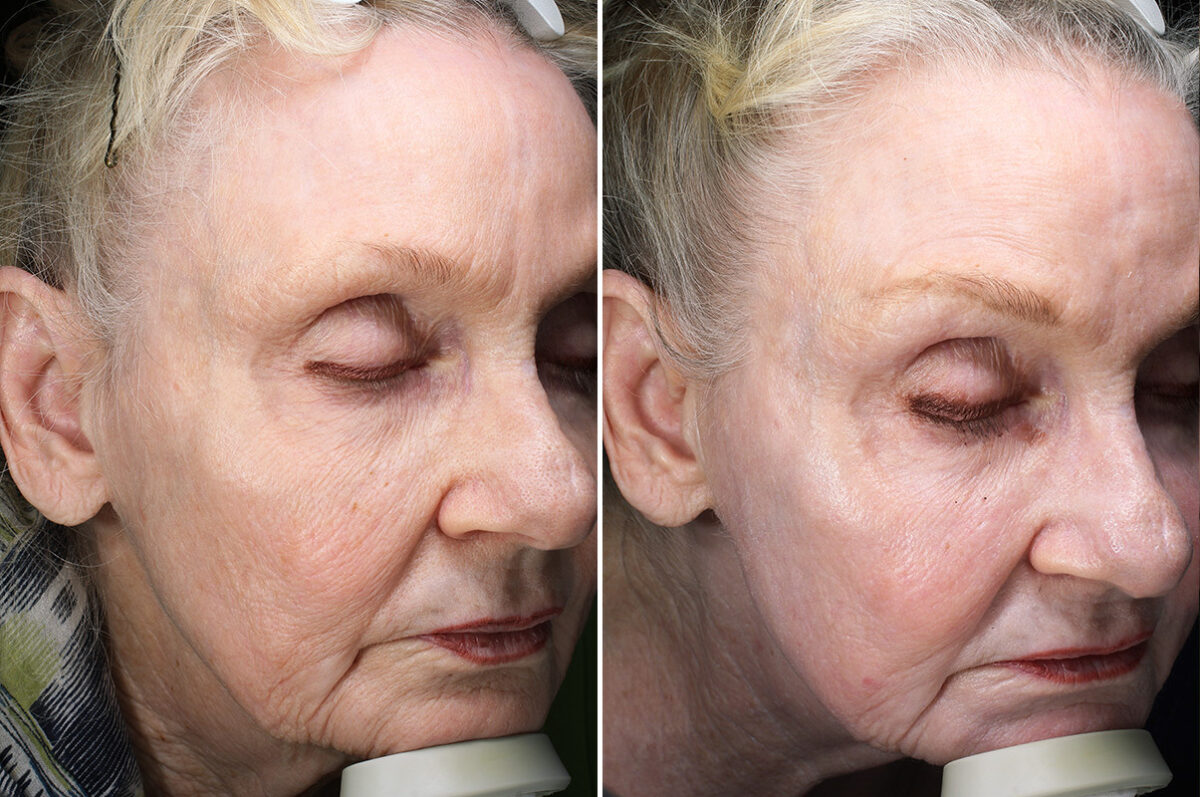 Before and after Skin Resurfacing by Dr. Shervin Naderi, Patient 43781