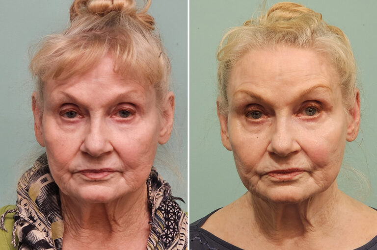 UltraClear laser resurfacing before and after of the face and neck: firmer, fresher skin
