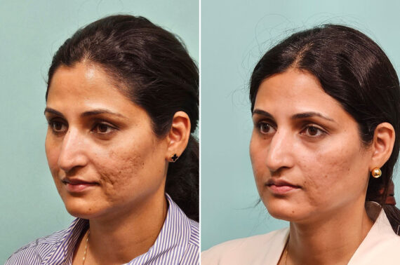 Before and after Skin Resurfacing by Dr. Shervin Naderi, Patient 43816