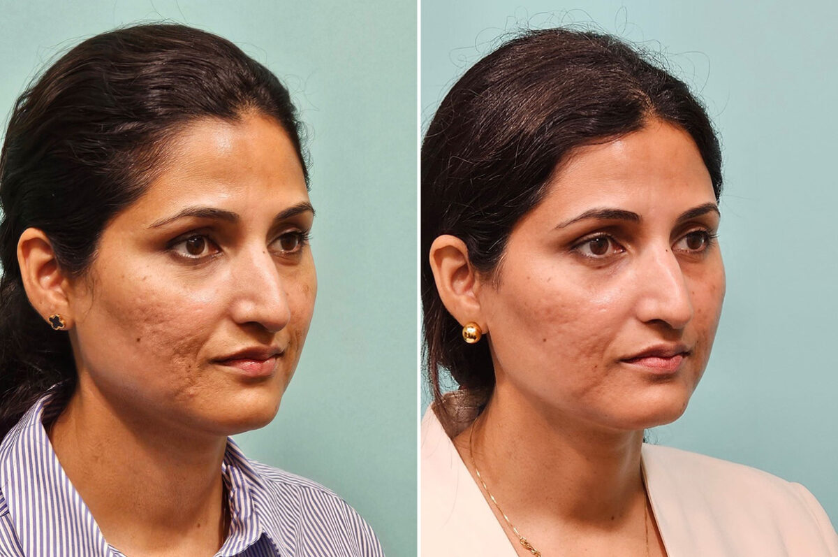 Patient 43816, Skin Resurfacing Before and After Photos Before and after Skin Resurfacing by Dr. Shervin Naderi, Patient 43816