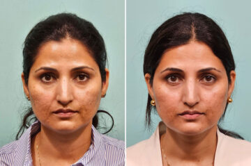 Before and after Skin Resurfacing by Dr. Shervin Naderi, Patient 43816