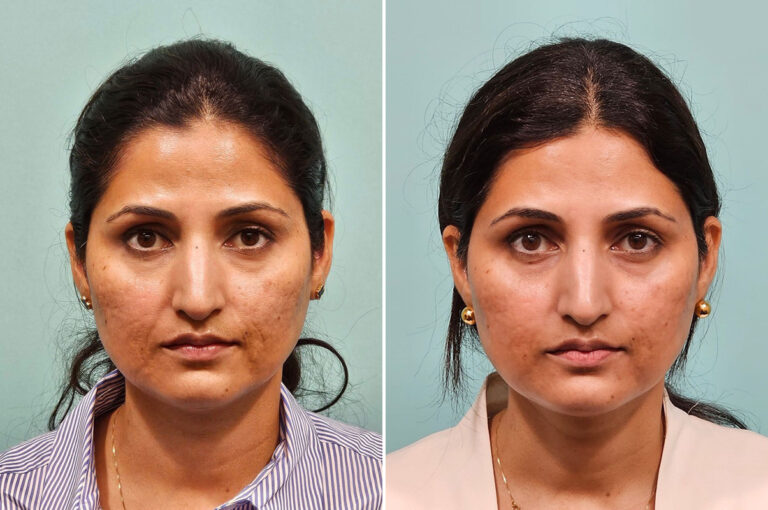 UltraClear laser resurfacing before and after on skin type IV: improved acne scars and skin texture
