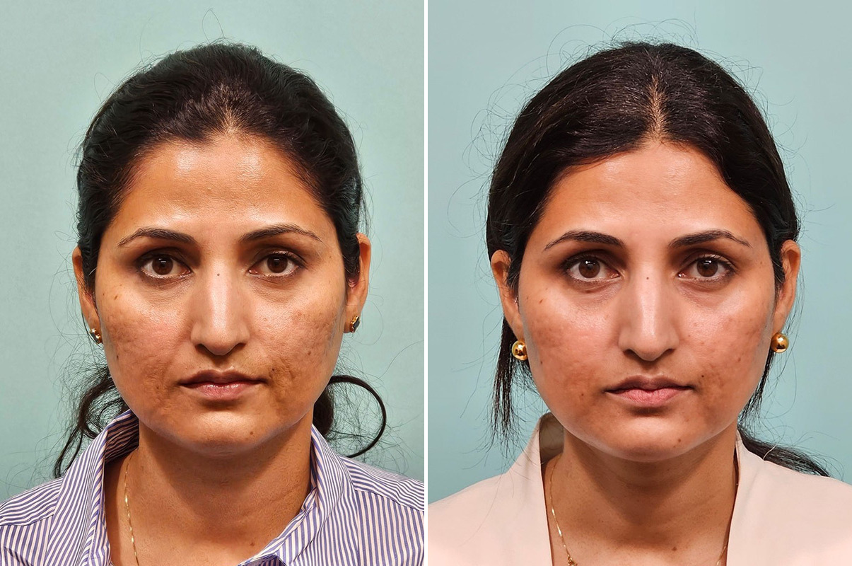 patient-43816-skin-resurfacing-before-after