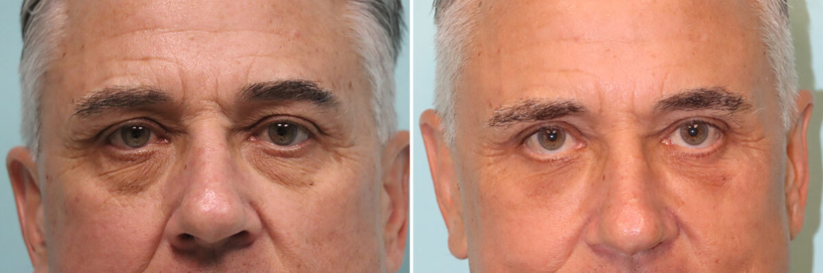 Before and after Blepharoplasty by Dr. Shervin Naderi, Patient 43827