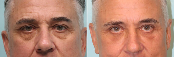 Before and after Blepharoplasty by Dr. Shervin Naderi, Patient 43827