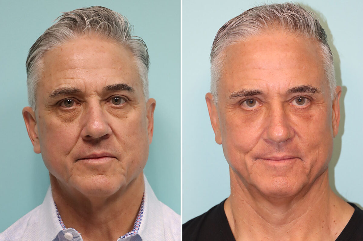 Before and after Blepharoplasty by Dr. Shervin Naderi, Patient 43827