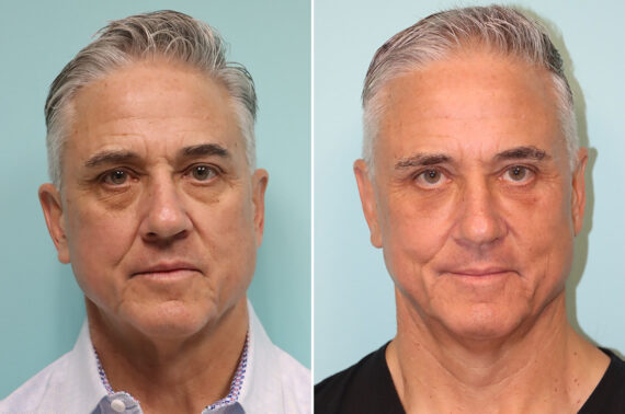 Before and after Blepharoplasty by Dr. Shervin Naderi, Patient 43827